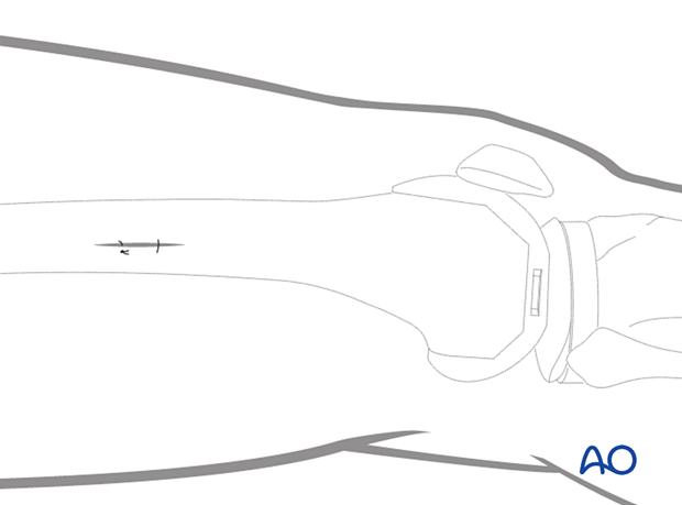 Closure of stab incisions