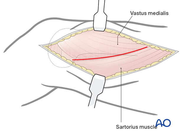 Deep dissection