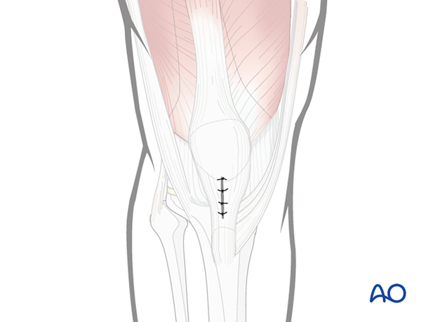 Wound closure