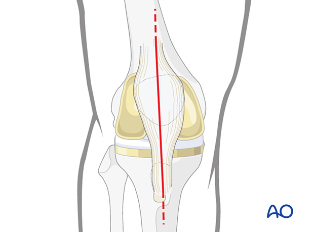 P450 Proximal tibia replacement