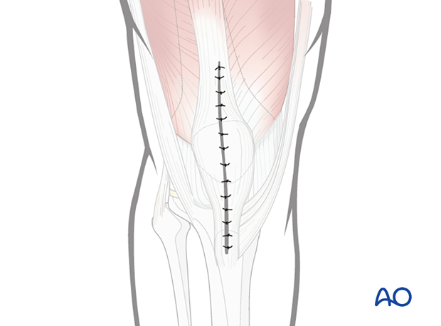 Wound closure