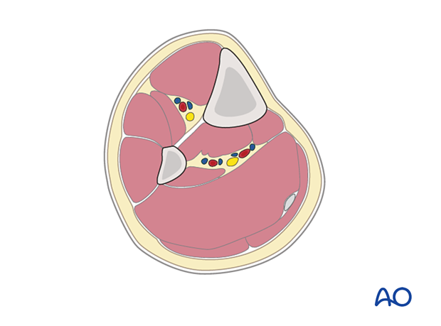 Triangular shape of the tibia