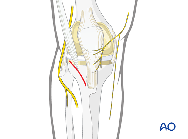 Proximal skin incision