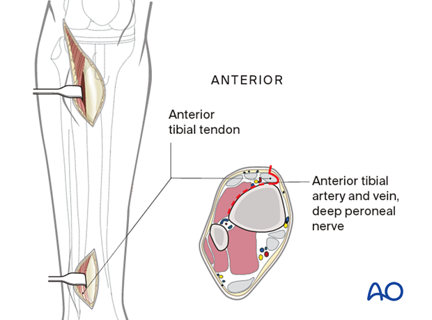 Distal incision