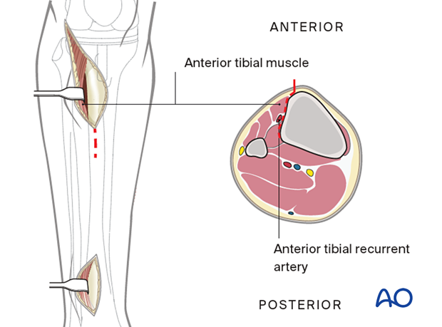 Deep dissection of stab incisions