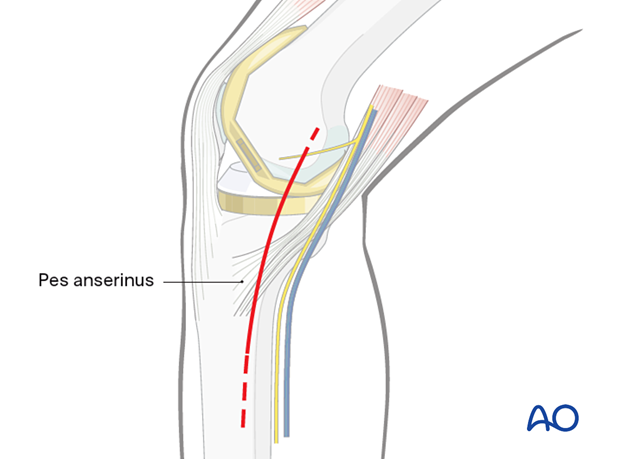 Skin incision