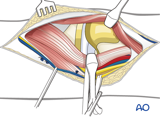 Deep dissection