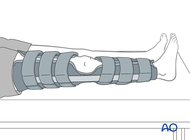 Non-hinged fracture brace