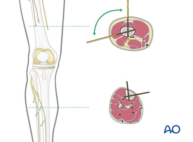 Safe zones for pin placement