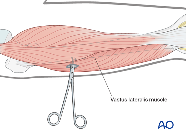 Soft tissue dissection