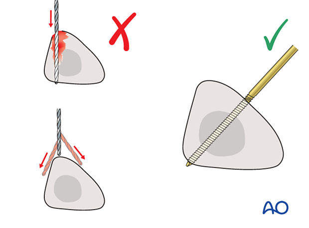 Tibial pin placement