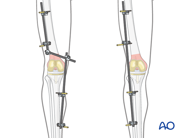 Principles of joint-spanning external fixation