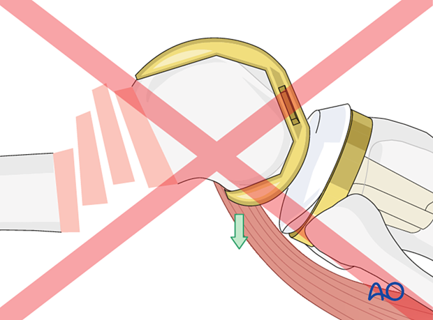 Hyperextension of the condylar block