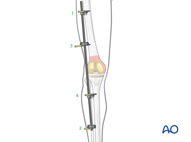 Single bar external fixator