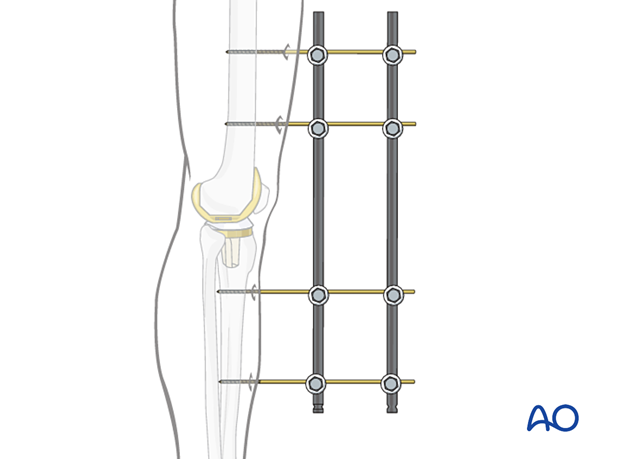 Further stability can be achieved with a supplementary bar