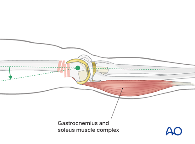 Flexion/extension