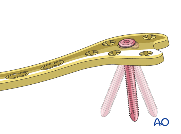 Variable angle plate