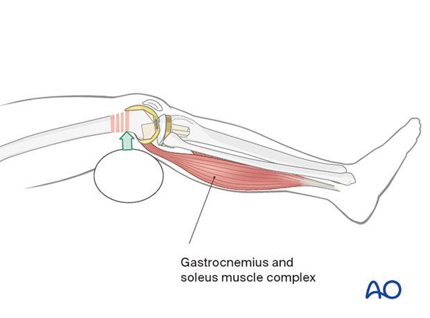 Flexion of the knee over a padded bump