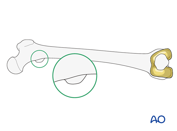 Compare the profile of the lesser trochanter with that of the contralateral leg