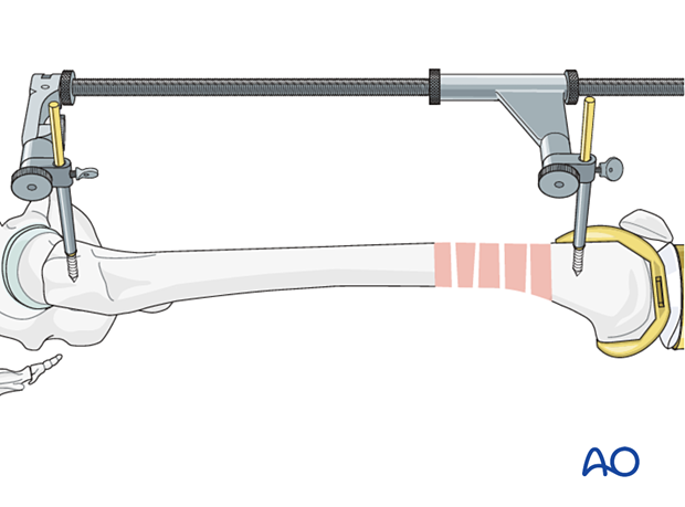 Femoral distractor