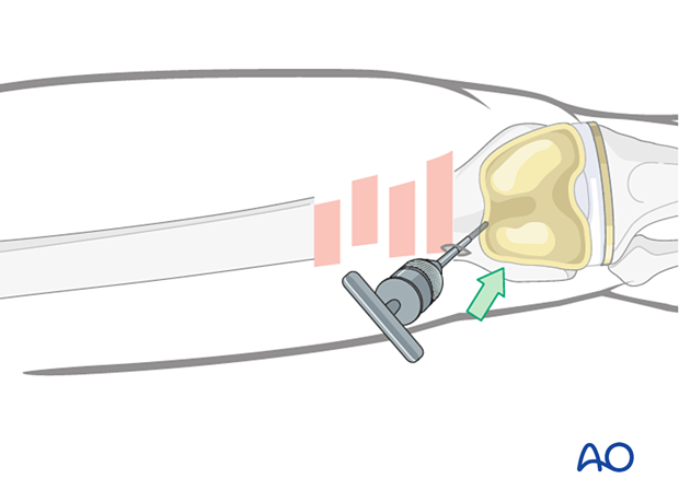 Schanz screw