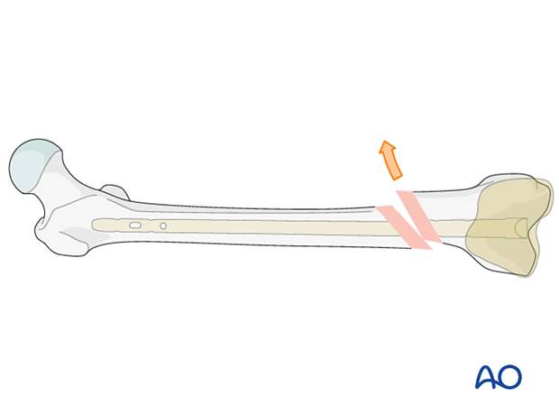 Poller or blocking screw