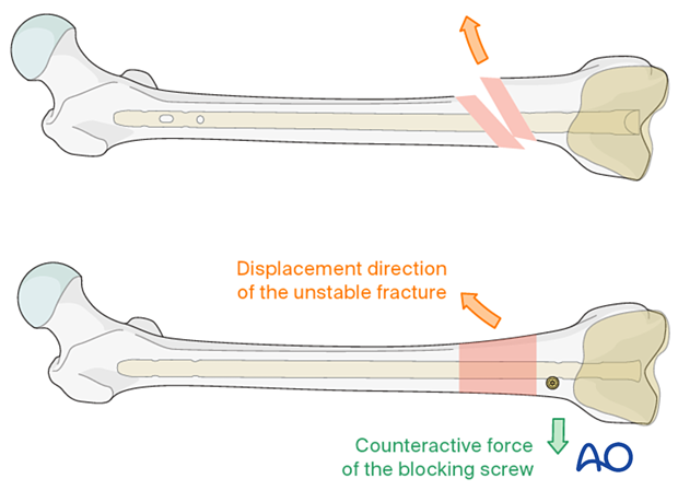 Counteractive force of the blocking screw