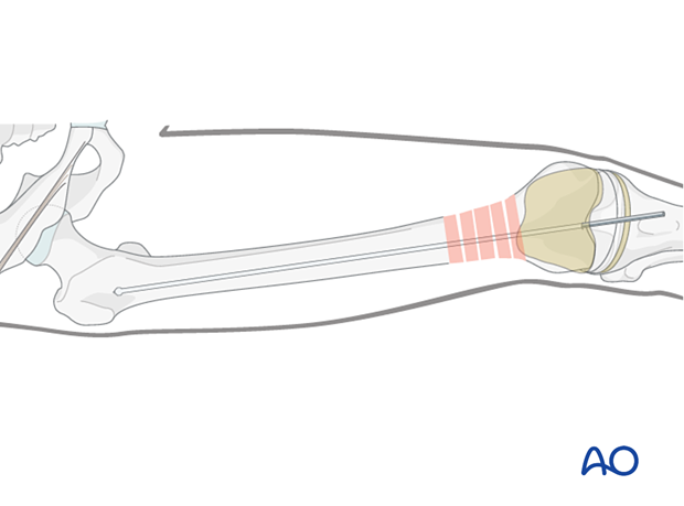 Guide wire insertion