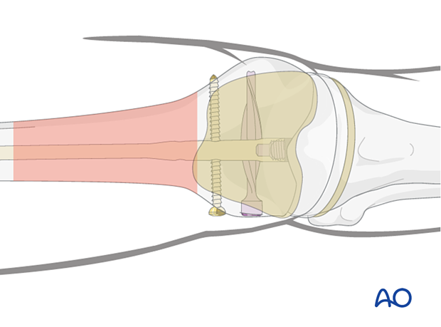 P160 Femur plate and retrograde nailing