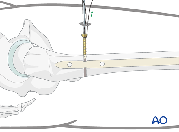 P150 Femur retrograde nailing