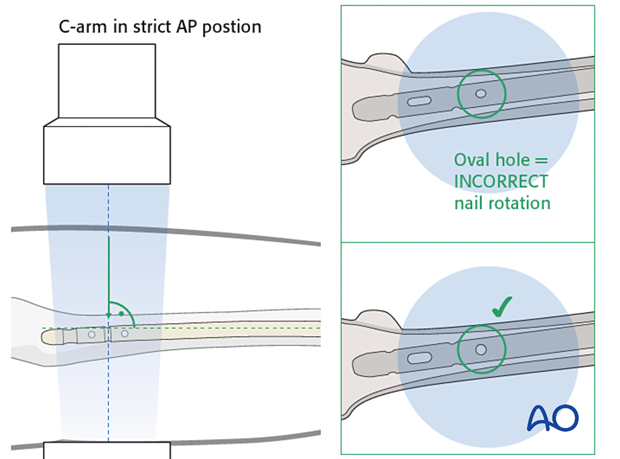 Drilling of screw hole