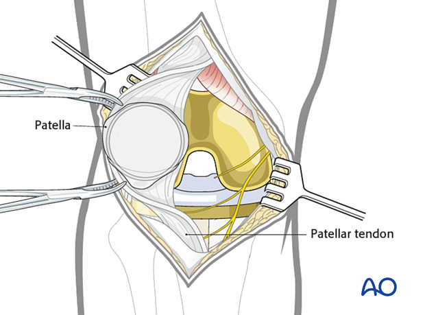 Eversion of the patella