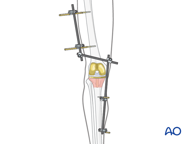 Tibia Temporary external fixator