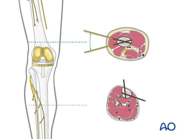 Add prosthesis, change illu name