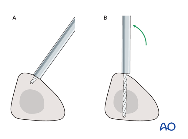 bridging external fixator temporary