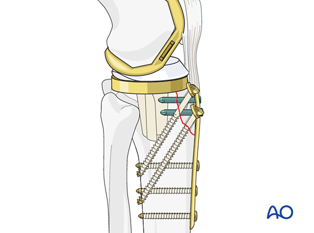 Plate fixation