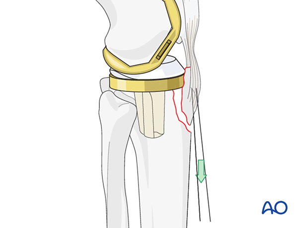 Large non-absorbable sutures can be inserted in the patellar tendon to aid in reduction