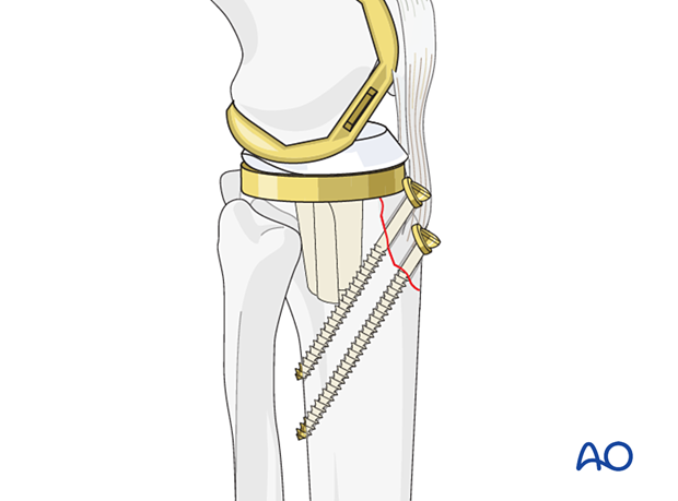 Lag screw fixation