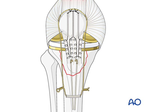 Tubercle fracture repair augmentation