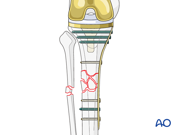 Bridging plate osteosynthesis