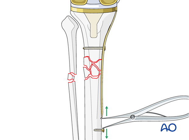 Push pull screws in combination with a Verbrugge clamp