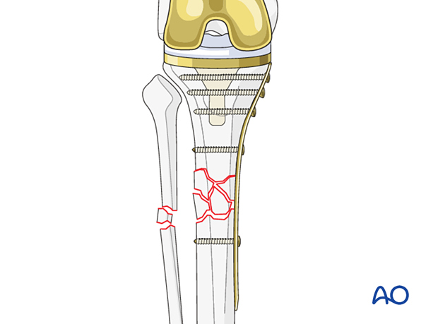 Plate fixation