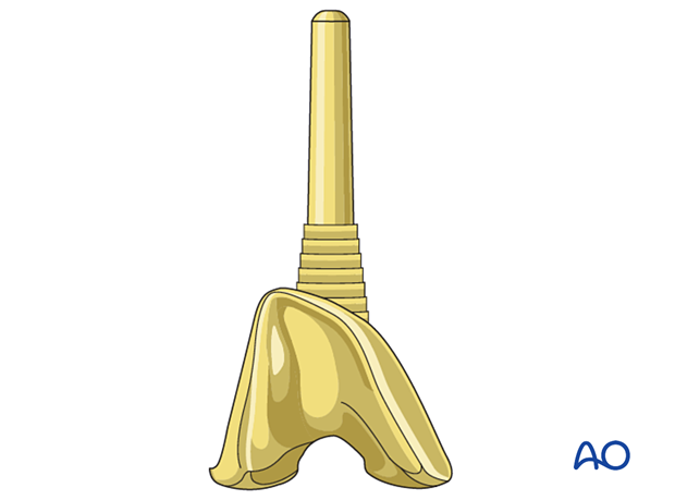 Supplemental metaphyseal fixation