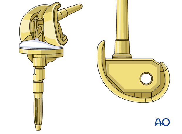 Hinged knee implant