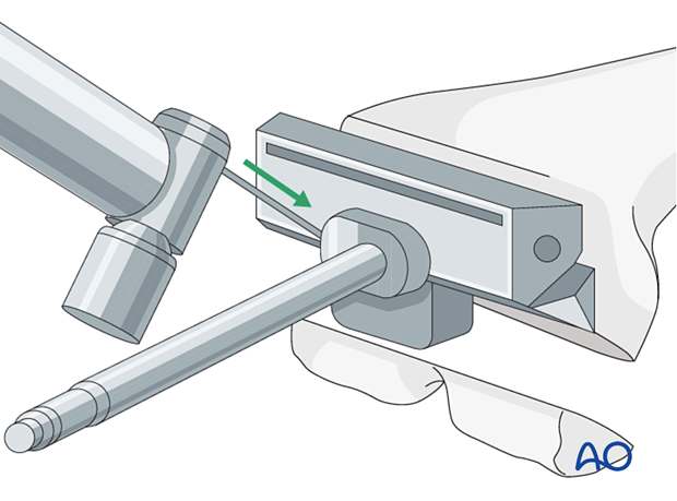 Preparation of the femur