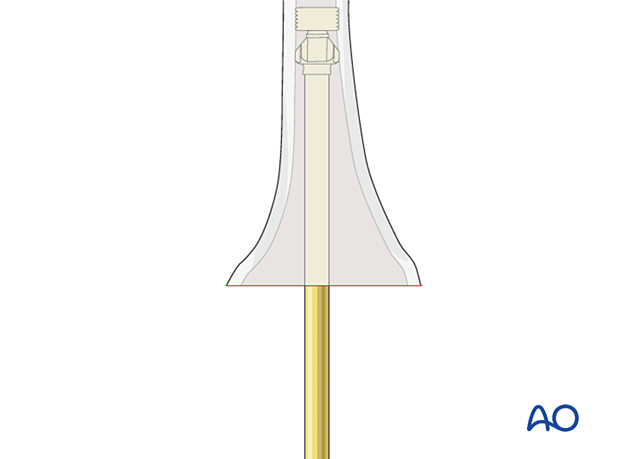 Cement restrictors