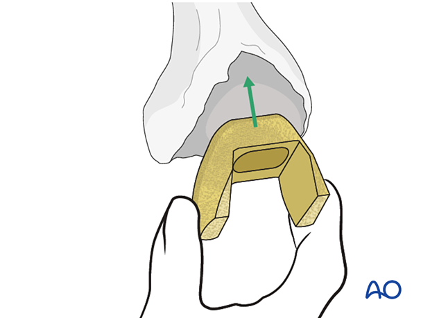 Supplemental femoral metaphyseal fixation