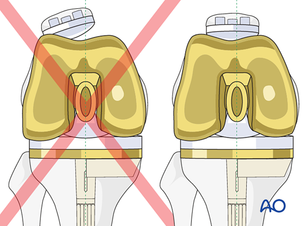 Insertion of the femoral component