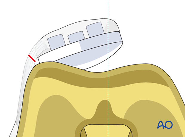 A lateral retinacular release and medial imbrication can be performed