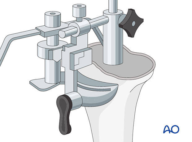 P425 Complete revision of tibial components with CCK